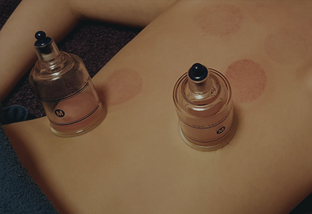 cupping massage